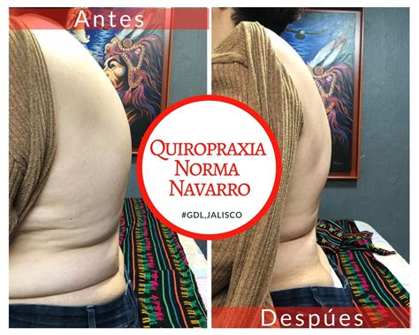 Cifosis Tratamientos Quiropr Cticos Quiropraxia Norma Navarro