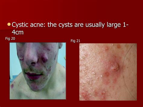 Ppt Acne Disorders Of Sebaceous Gland Powerpoint Presentation Free Download Id9577232