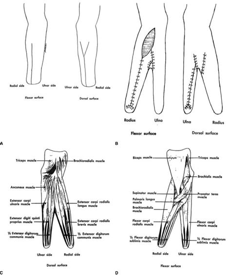 The Krukenberg Procedure; After the devastating amputation of a hand, a ...