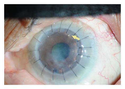 Glaucoma And Corneal Transplant Procedures Pmc