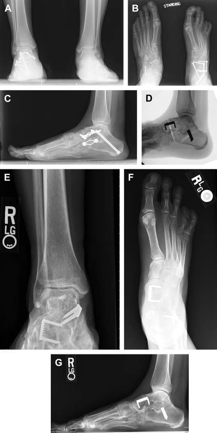 Management Of The Malunited Triple Arthrodesis Foot And Ankle Clinics