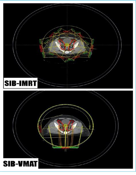 Figure 1 From Simultaneous Integrated Boost Plan Comparison Between