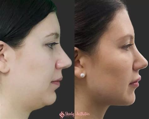 Jawline Fillers Before After Results At Skinly