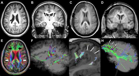 Subcortical Band Heterotopia Disrupting White Matter Tracts Journal