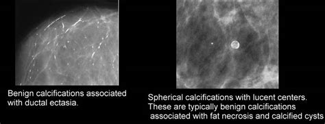 Basic Information About Mammograms