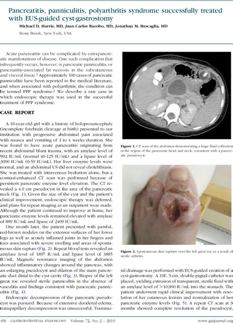 Pancreatitis Panniculitis Polyarthritis Syndrome Successfully Treated With Eus Guided Cyst