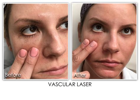 Vascular Laser Archives Skin Rejuvenation Clinic Skin Rejuvenation Clinic