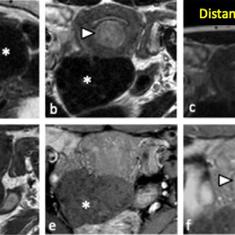 Pre Procedural Mri Findings Sagittal A And Axial Fse T Weighted B