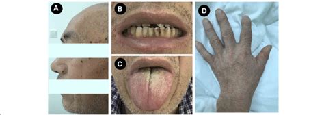 Macroglossia Acromegaly