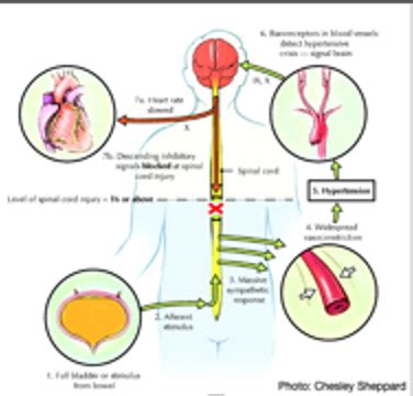 Neuro Disorders Final Exam Flashcards Quizlet