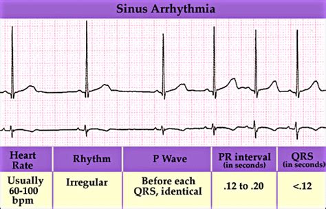 Sinus Arrhythmia