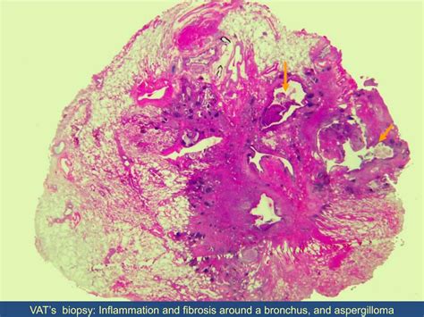 PPT - A 48-year-old man with blood tinged sputum for 8 months ...