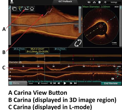 3d Bifurcation Carina View Display Cardiology Apps