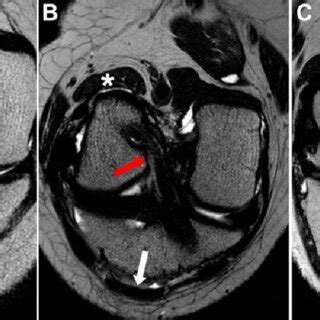 MRI scans after ACL reconstruction: oblique coronal view. White arrow ...