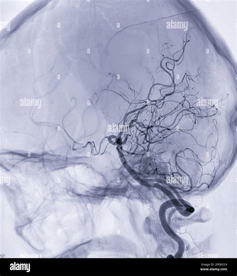 Imagen De Angiograf A Cerebral O Arteria Cerebral Potesterior De