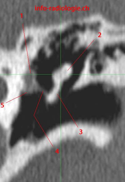 Ct Scan Of The Middle Ear