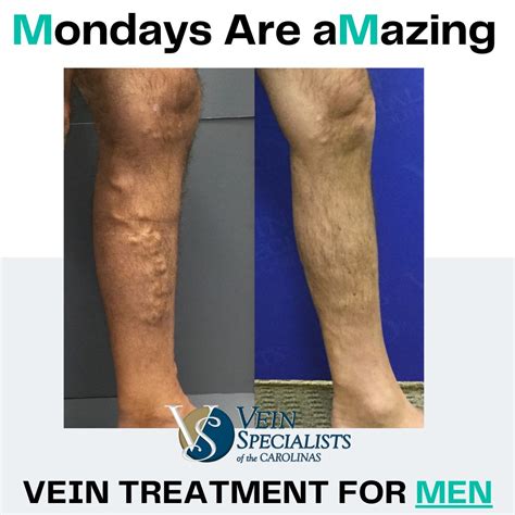 What Is The Difference Between Spider Veins And Varicose Veins Vein Specialists Of The Carolinas