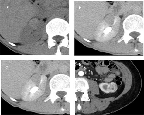 A C A 49 Year Old Man With Epithelioid Angiomyolipoma Unenhanced Ct