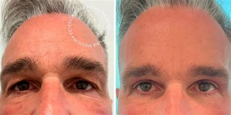 Oculoplastia en Málaga cirugía ocular PURÄ Medicina Estética