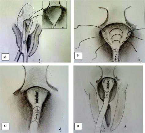 Single Stage Female Epispadias Repair By Combined Infrasymphyseal Bladder Neck Plication And