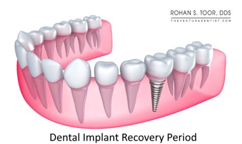 Dental Implant Healing Time How Long And What To Expect Rohan Toor