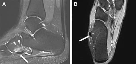 Mr Imaging Of The Midfoot Including Chopart And Lisfranc Joint