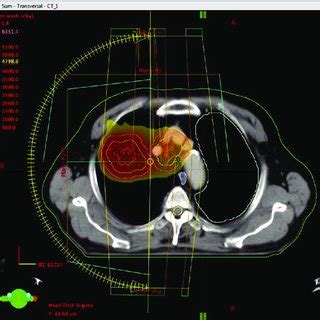 Example Of Dose Distribution In Volumetric Modulated Arc Therapy Plan