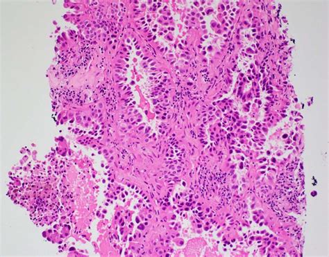 Pulmonary Adenocarcinoma With Lepidic Growth Pattern Bosnianpathology