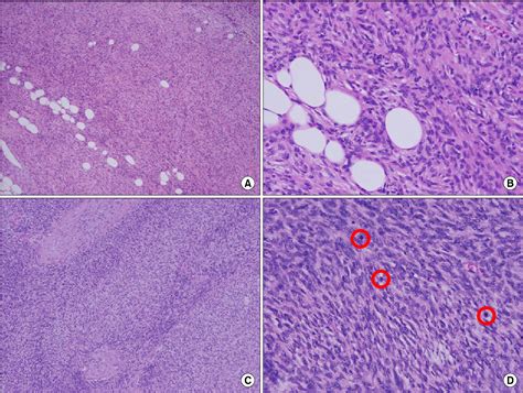 Dermatofibrosarcoma Pathology Outlines