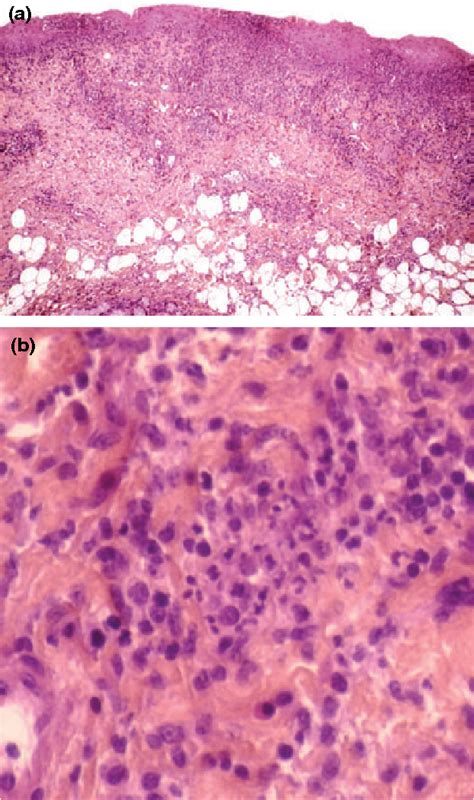 Herpetic Stomatitis Histology