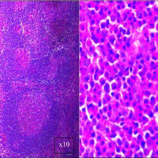 Pathology images of the excisional biopsy revealed lymph nodes with ...