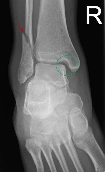 Ankle X-ray Interpretation | Ankle Fracture | Geeky Medics