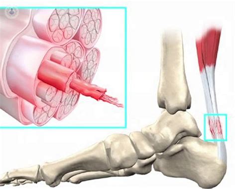 Tendinitis O Tendinoss Todo Lo Que Debes Saber Top Doctors