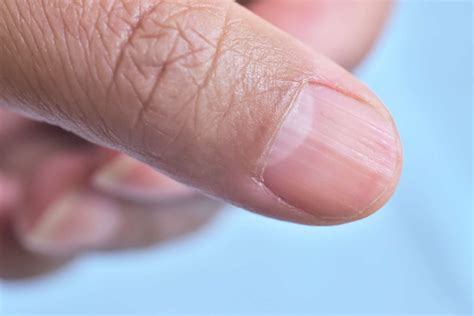 Patient Bizarre cette maladie étrange fait disparaitre les ongles des