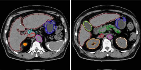 Pdf Segmentation Of Multiple Organs In Non Contrast D Abdominal Ct