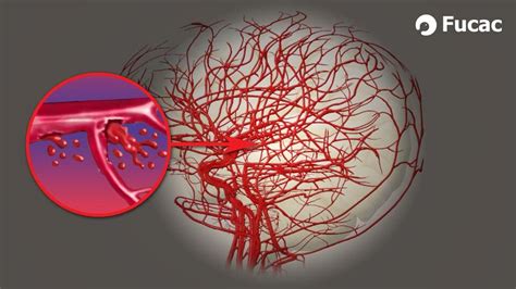 ACV Accidente Cerebro Vascular Fucac