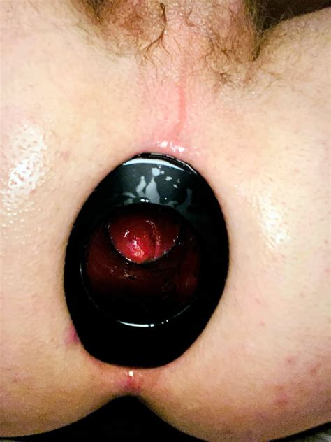 XXL MEO Anal Stretching Ring Pics XHamster