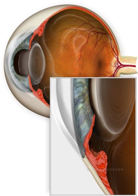 Narrow angle anterior chamber patient education illustration