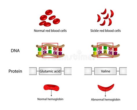 Sickle Cell Anemia Disease Normal And Sickled Red Blood Cells Stock