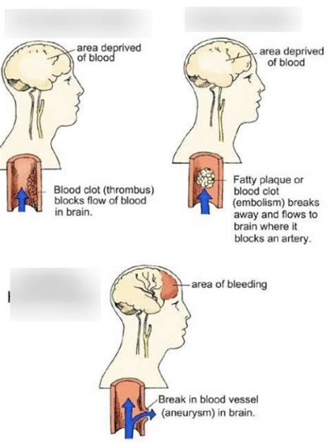 Diagram Of Types Of Strokes Quizlet