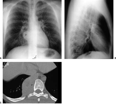 Radiology Of Mediastinal Masses Thoracic Key