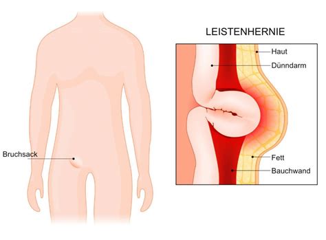 Tapp Bei Leistenbr Chen Infos Tapp Spezialisten