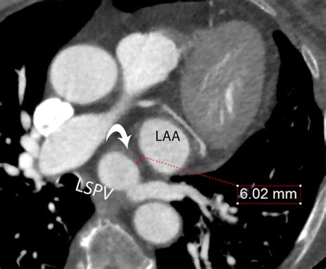 Pre And Postprocedural Ct Of Transcatheter Left Atrial Appendage