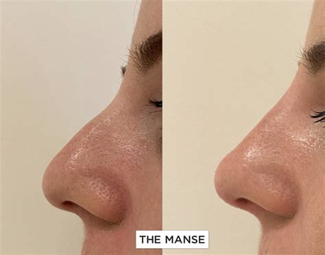 Non Surgical Nose Treatments Best Cosmetic Clinic Sydney Advanced