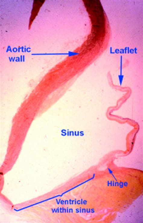 Clinical Anatomy Of The Aortic Root Heart