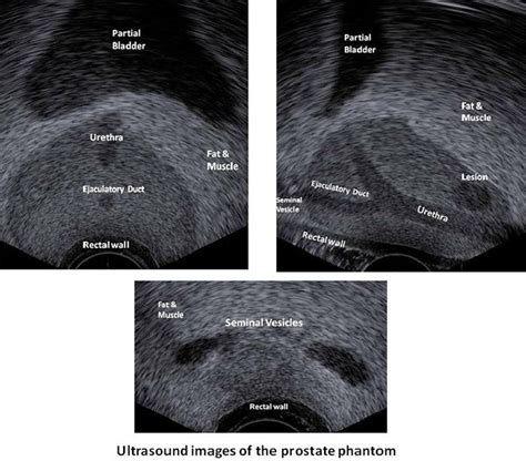 Multi Modality Prostate Phantom Ultrasound Images