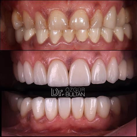 Intraoral Photos Of Yesterday S Case Full Mouth Ips E Max Crown Case