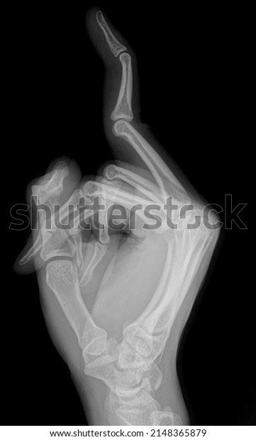 Middle Finger Xray Side View Stok Fotoğrafı 2148365879 Shutterstock