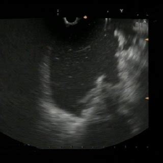 Endoscopic ultrasound view of pancreatic pseudocyst. | Download Scientific Diagram