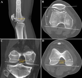 Characterization Of The CT Based Risk Factors For Concomitant